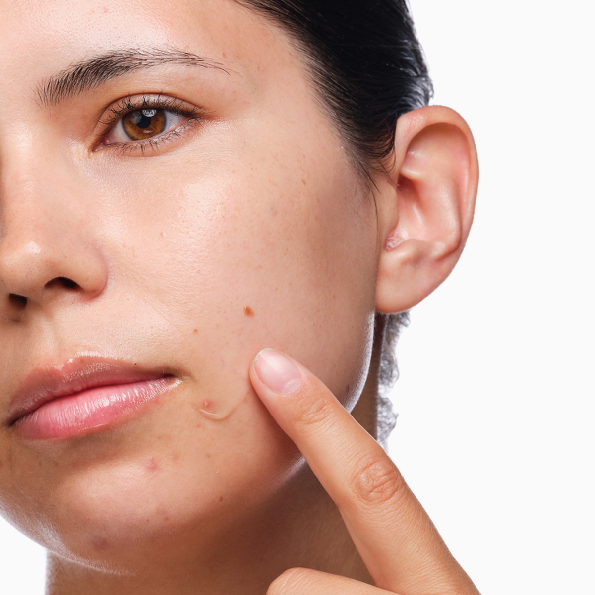 the-acne-set-m5 rdn-the-acne-set-application.png