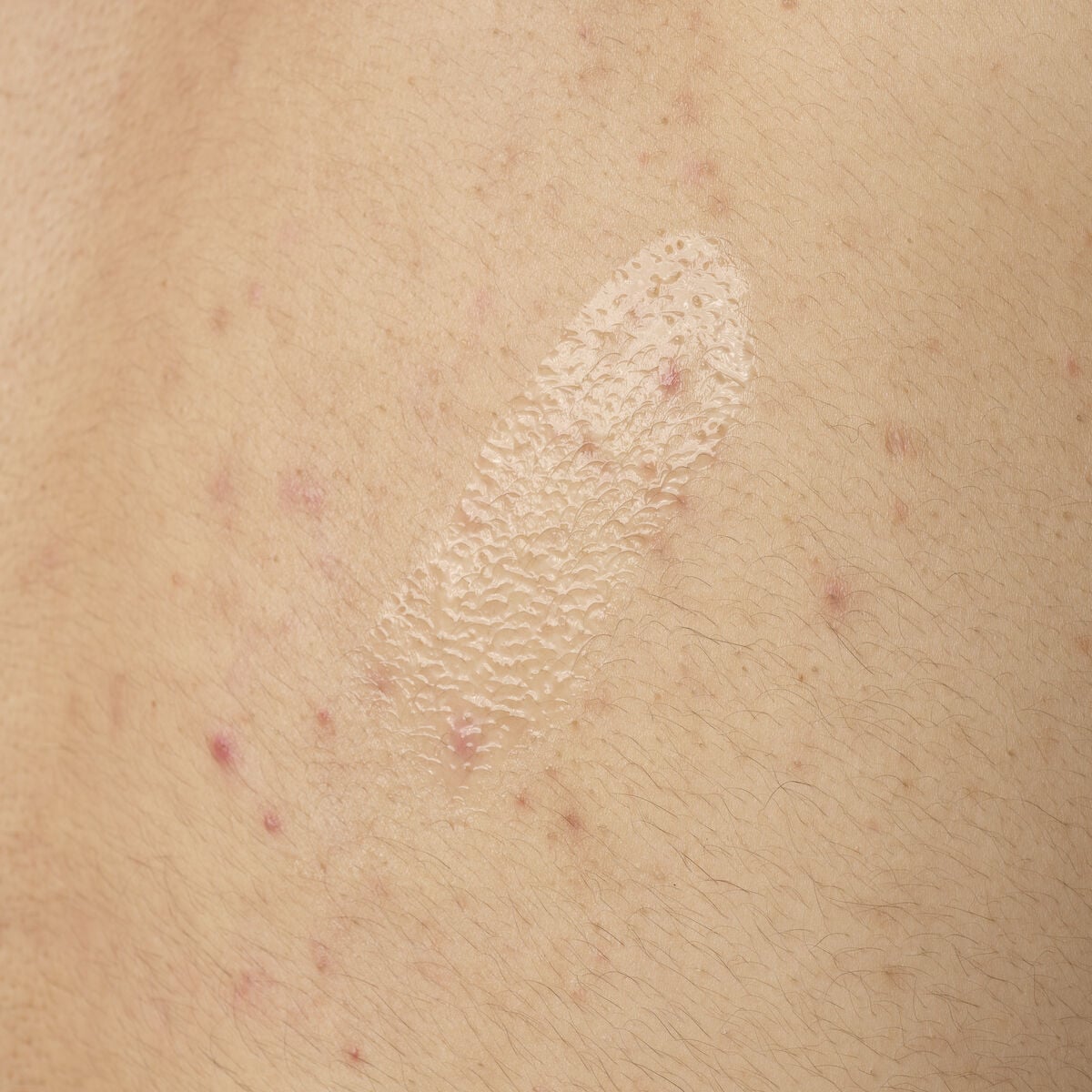 salicylic-acid-0-5-body-serum-c0 ORD-salicylic-acid-05-body-240ml-application.jpg
