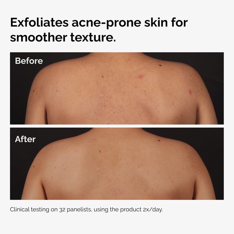 the-body-care-collection-l8 ord-salicylic-acid-body-serum-before-after-graphic-NA.jpg