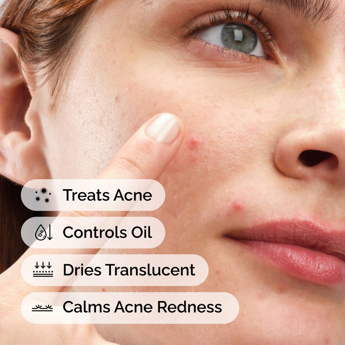 sulfur-10-powder-to-cream-concentrate-z8 ord-sulfur-10pct-powder-to-cream-concentrate-model-application-with-benefits-acne.jpg